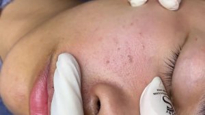 196 • Acne collection • АСМР • Relax Spa