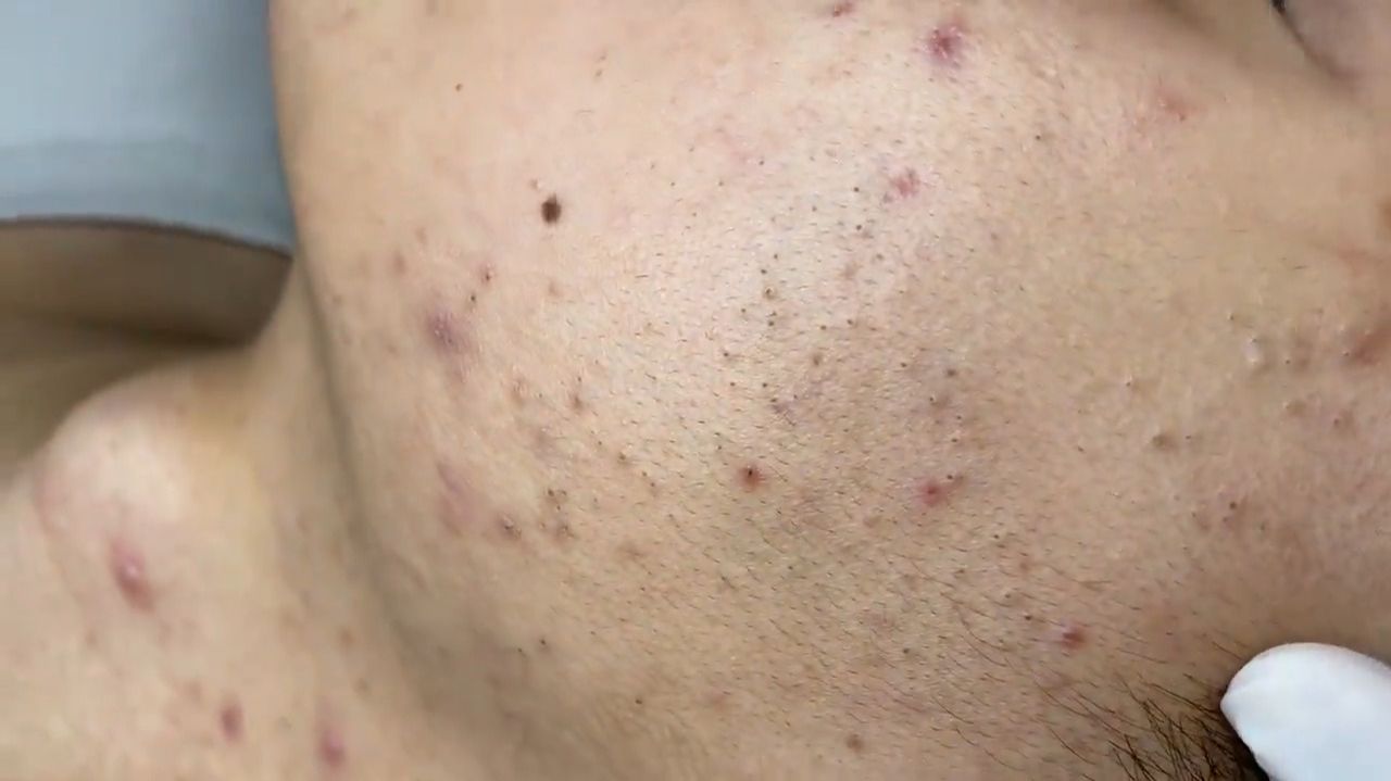 197 • Acne collection • АСМР • Relax Spa смотреть онлайн