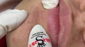 198 • Acne collection • АСМР • Relax Spa