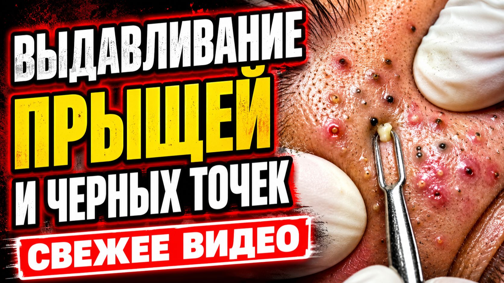ВЫДАВЛИВАНИЕ ПРЫЩЕЙ СВЕЖЕЕ ВИДЕО (11) смотреть онлайн