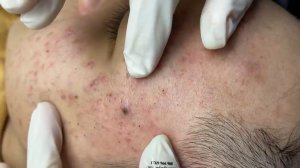 201 • Acne collection • АСМР • Relax Spa