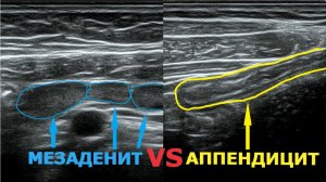 Как отличить мезаденит от аппендицита на УЗИ: два примера