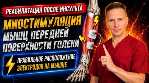 Миостимуляция мышц передней поверхности голени. Правильное расположение электродов. Отвисшая стопа.