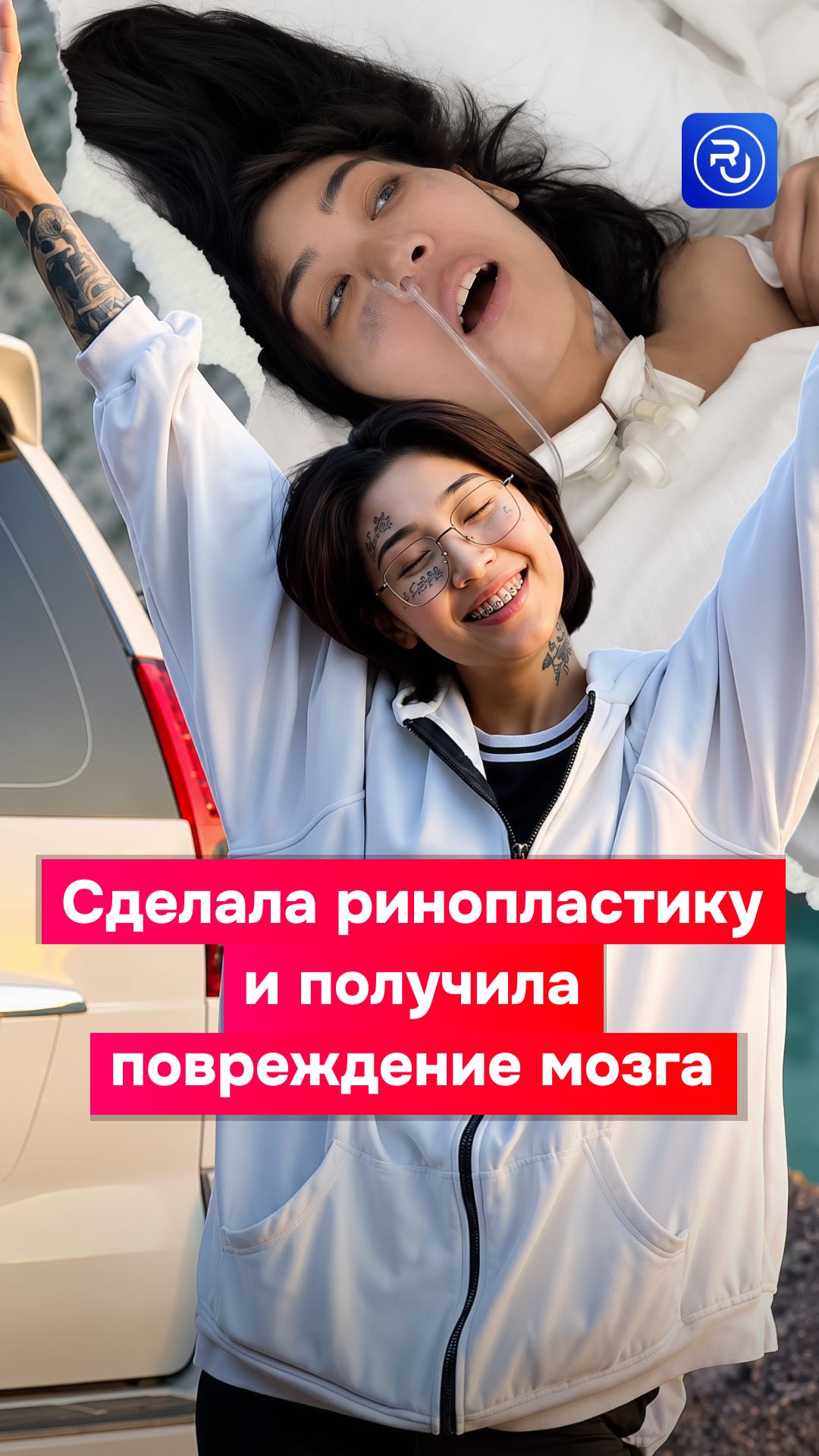 Сделала ринопластику и получила повреждение мозга