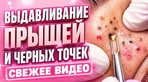 ВЫДАВЛИВАНИЕ ПРЫЩЕЙ СВЕЖЕЕ ВИДЕО (10)