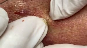 ВЫДАВЛИВАЕТ ПРЫЩИ И УГРИ. СОЧНОЕ РЕЛАКС ВИДЕО