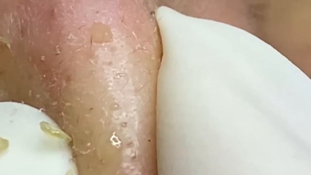 Удаление акне, прыщей и комедонов на разных зонах лица смотреть онлайн