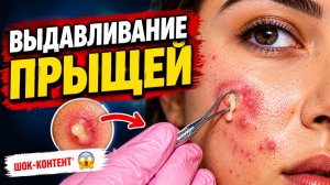 ВЫДАВЛИВАНИЕ ПРЫЩЕЙ И ОЧИЩЕНИЕ КОЖЫ ОТ ЧЕРНЫХ ТОЧЕК (1)
