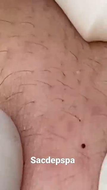 Goodbye Blackhead (sacdepspa #0379)