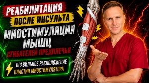 Реабилитация после инсульта. Миостимуляция, сгибатели кисти и пальцев. Расположение электродов.