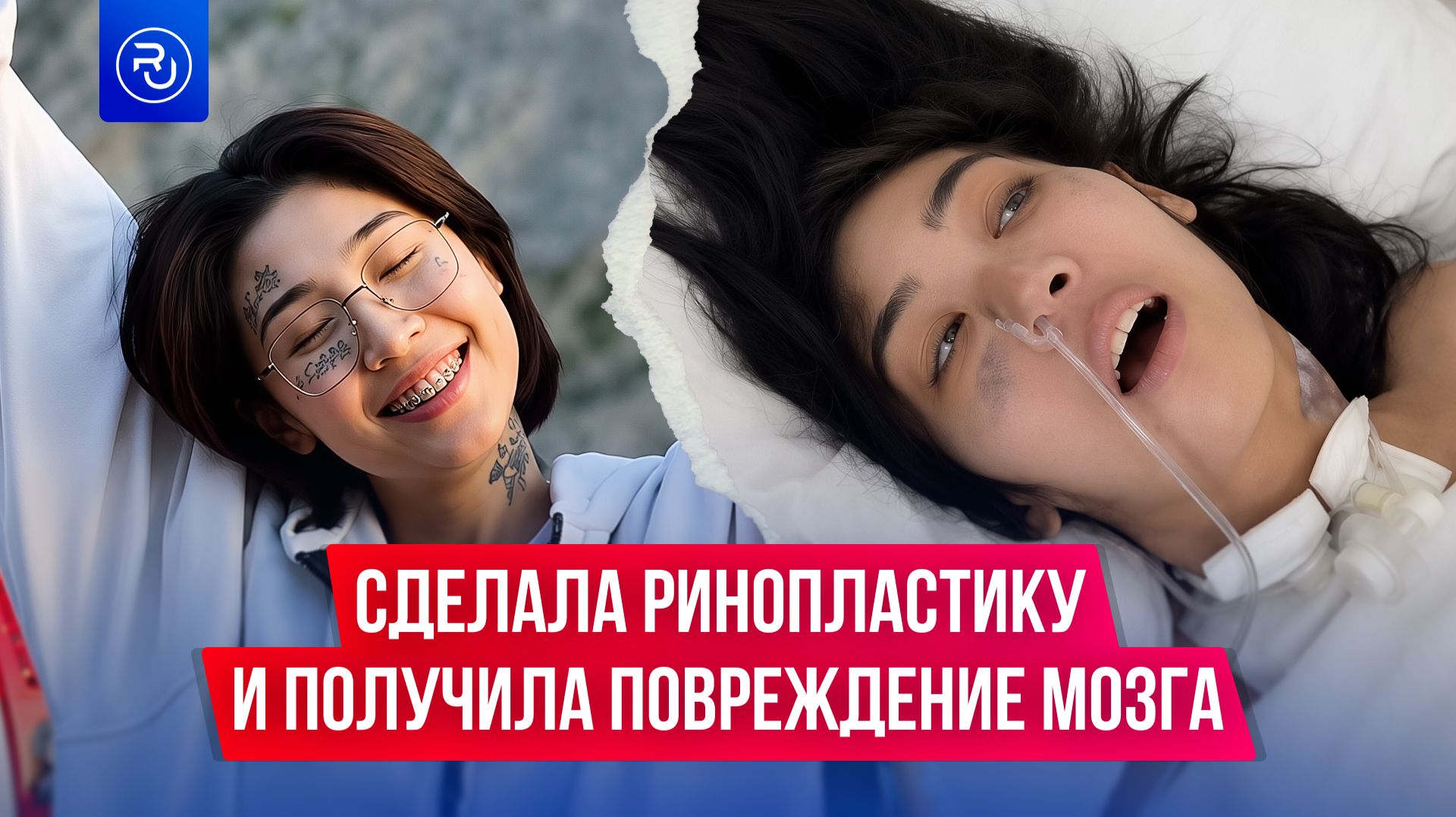 Сделала ринопластику и получила повреждение мозга