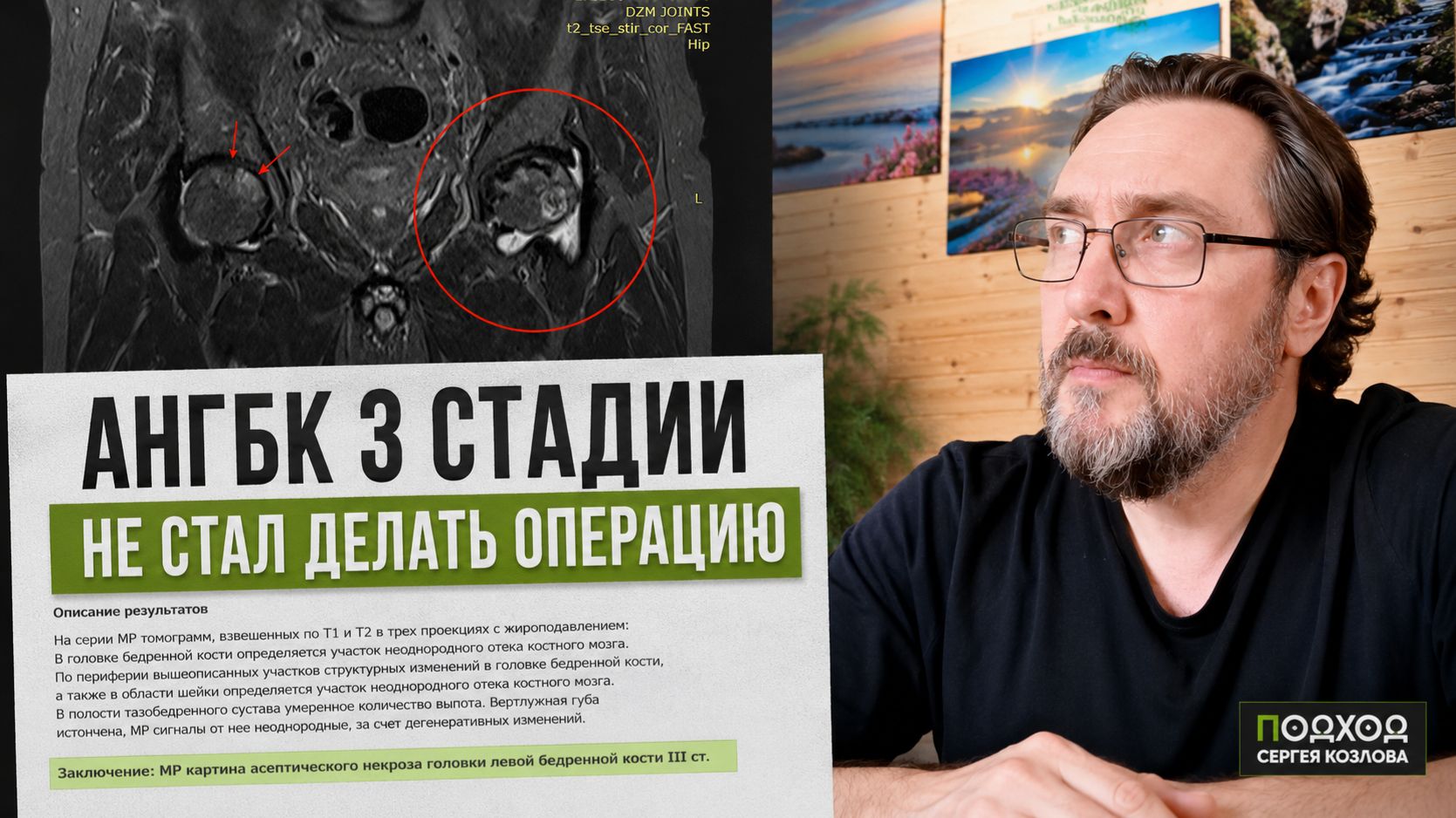 Асептический некроз 3 стадии: врачи рекомендовали эндопротезирование, а я восстановился без операции