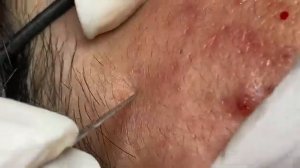 ВЫДАВЛИВАЕТ ПРЫЩИ И УГРИ. СОЧНОЕ РЕЛАКС ВИДЕО