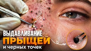 ВЫДАВЛИВАНИЕ ПРЫЩЕЙ СВЕЖЕЕ ВИДЕО (12)