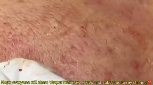 ВЫДАВЛИВАЕТ ПРЫЩИ И УГРИ. СОЧНОЕ РЕЛАКС ВИДЕО