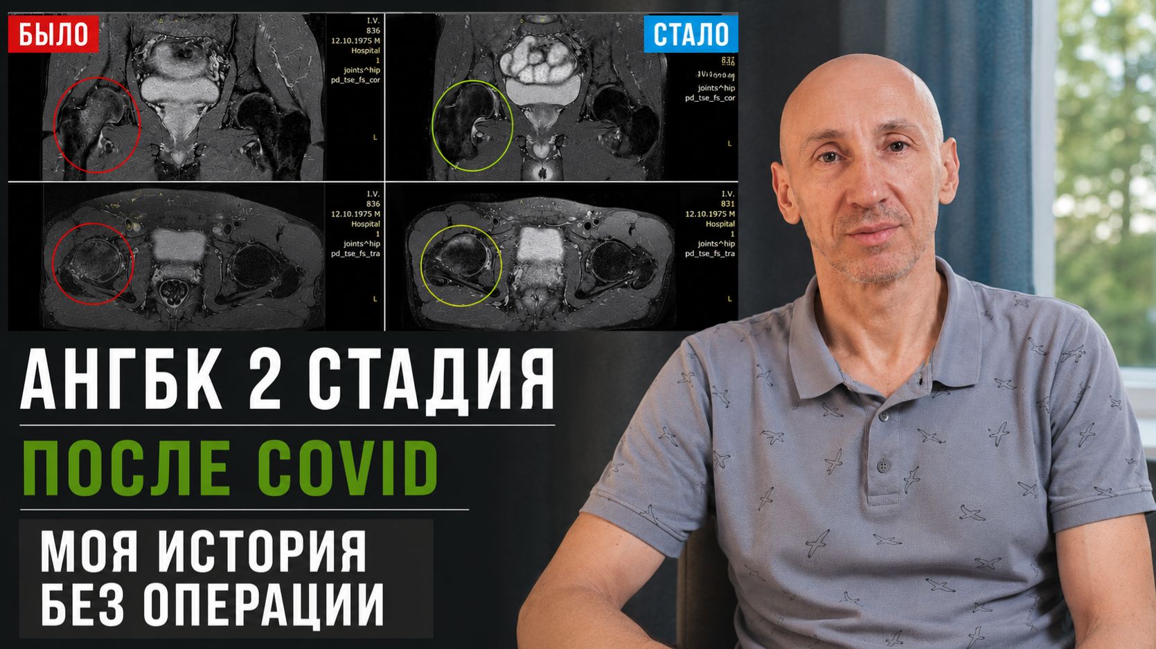 Асептический некроз 2 стадии после COVID: история восстановления без операции