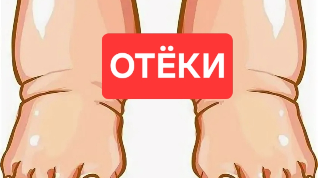 Отеки.Как убратт отеки.Лучшее средство от отеков.