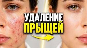 ВЫДАВЛИВАНИЕ ПРЫЩЕЙ СВЕЖЕЕ ВИДЕО (9)