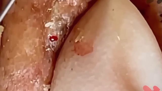 #675 Чистка лица от угрей и акне. Выдавливание прыщей. Удаление черных точек и комедонов смотреть онлайн