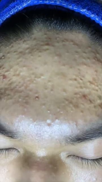 Full video in the comment section sacdepspa acne