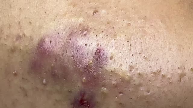 Воспалительное акне с кровью — часть 1