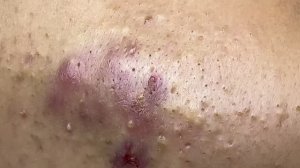 Воспалительное акне с кровью — часть 1