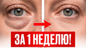 НЕОЖИДАННЫЕ причины  МЕШКОВ под глазами и 1 ЛУЧШЕЕ решение / Как убрать отеки под глазами?