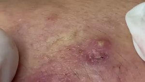 ВЫДАВЛИВАНИЕ ПРЫЩЕЙ И ОЧИЩЕНИЕ КОЖЫ ОТ ЧЕРНЫХ ТОЧЕК (23)
