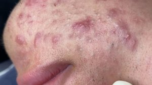 203 • Acne collection • АСМР • Relax Spa