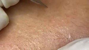 ВЫДАВЛИВАЕТ ПРЫЩИ И УГРИ. СОЧНОЕ РЕЛАКС ВИДЕО