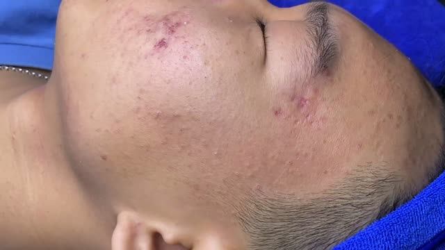 Воспалительное акне с кровью — часть 3