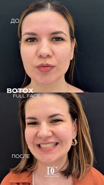 Botox Full Fase