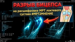 БОЛЬ В БИЦЕПСЕ руки при полном РАЗРЫВЕ БИЦЕПСА и АРТРОЗЕ локтя на РАСШИФРОВКЕ МРТ локтевого сустава