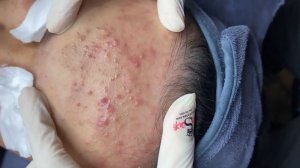 199 • Acne collection • АСМР • Relax Spa