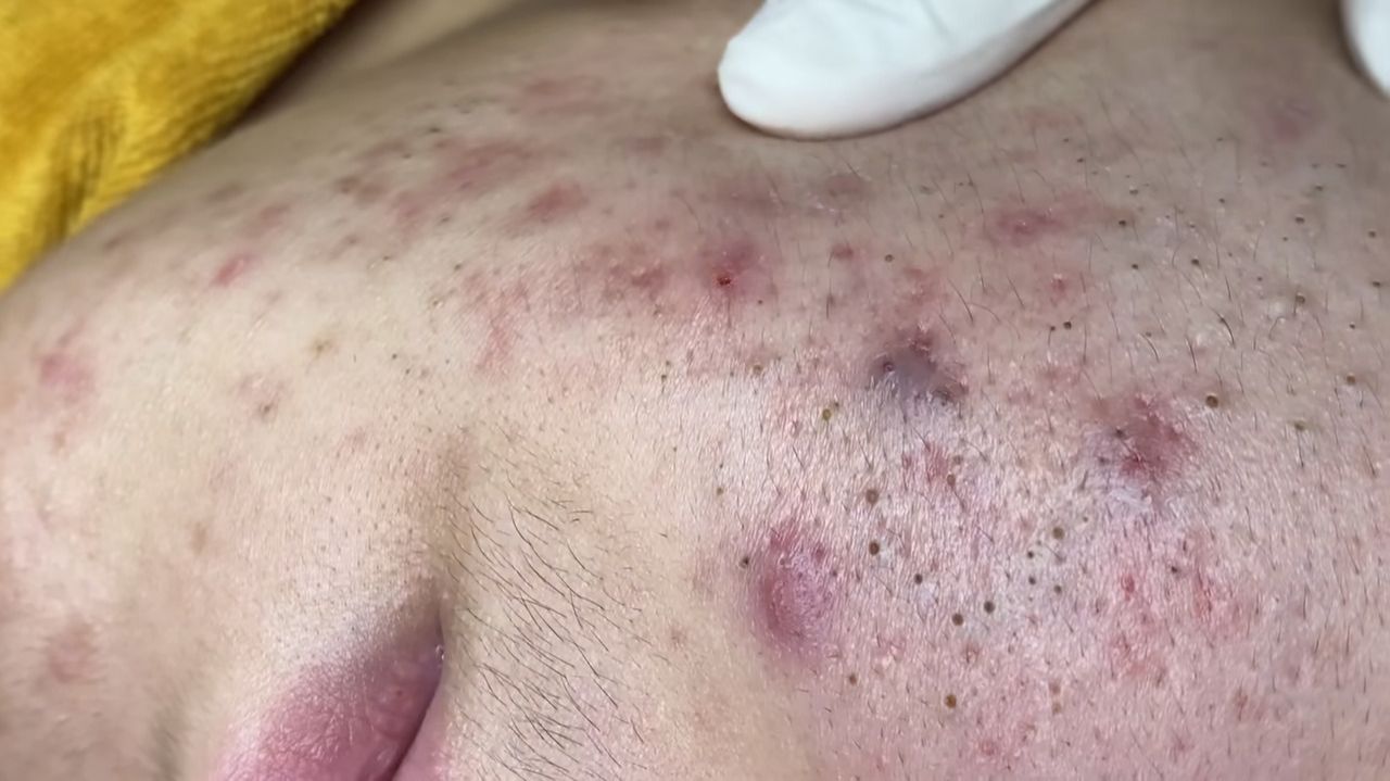 205 • Acne collection • АСМР • Relax Spa смотреть онлайн