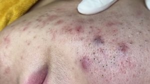 205 • Acne collection • АСМР • Relax Spa
