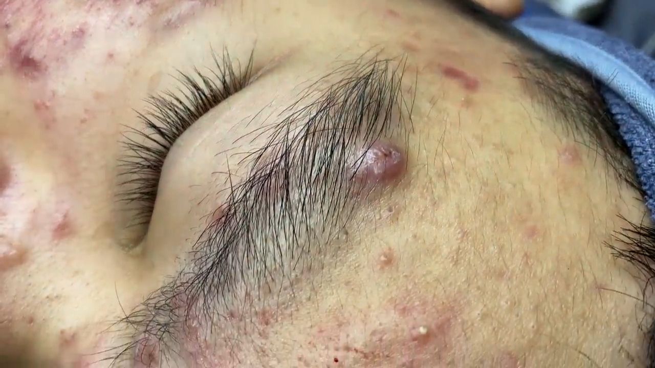 204 • Acne collection • АСМР • Relax Spa смотреть онлайн