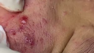 ВЫДАВЛИВАНИЕ ПРЫЩЕЙ И ОЧИЩЕНИЕ КОЖЫ ОТ ЧЕРНЫХ ТОЧЕК (26)