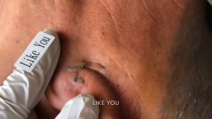 У БОЛЬШИНСТВА КОМЕДОНОВ ЗА УШАМИ ДЕЙСТВИТЕЛЬНО МНОГО В XXXXX