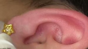 ВЫДАВЛИВАНИЕ ПРЫЩЕЙ И ОЧИЩЕНИЕ КОЖЫ ОТ ЧЕРНЫХ ТОЧЕК (22)