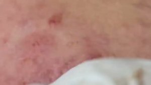 ВЫДАВЛИВАНИЕ ПРЫЩЕЙ И ОЧИЩЕНИЕ КОЖЫ ОТ ЧЕРНЫХ ТОЧЕК (24)