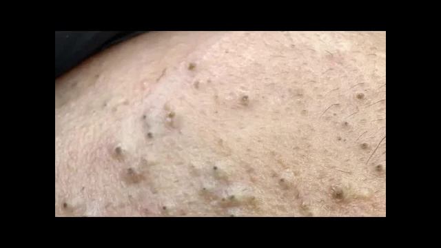 Уход за лицом | Удаление черных точек и сужение пор смотреть онлайн