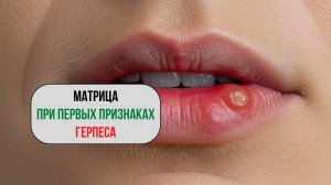 Звуковая поддержка при первых признаках герпеса | Матрица для гармонизации