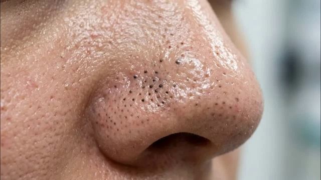 Удаление черных точек [ASMR] и лечение акне - процедура очищения лица