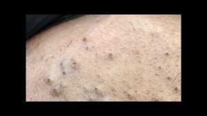 Техники удаления себума | Глубокое очищение кожи