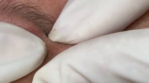 ВЫДАВЛИВАЕТ ПРЫЩИ И УГРИ. СОЧНОЕ РЕЛАКС ВИДЕО