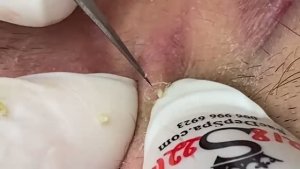 ВЫДАВЛИВАНИЕ ПРЫЩЕЙ И ОЧИЩЕНИЕ КОЖЫ ОТ ЧЕРНЫХ ТОЧЕК (25)