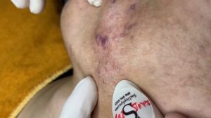 209 • Acne collection • АСМР • Relax Spa