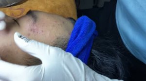 Жесткое удаление прыщей, комедонов