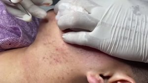 Удаление комедонов — открытые и закрытые